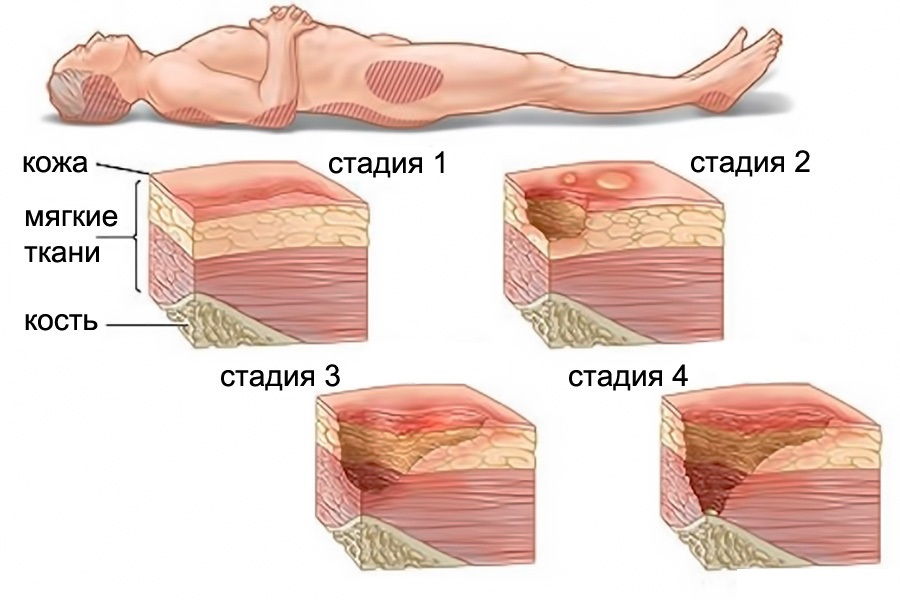 4 стадии пролежней